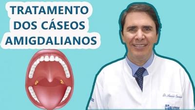 Como Remover Cáseos Amigdalianos - Remédio caseiro e riscos de remover ou tirar os cáseos amigdalianos