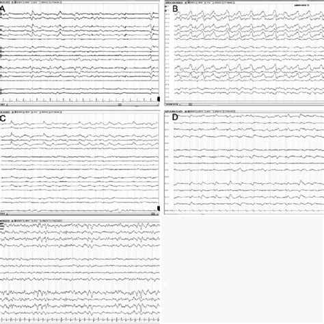 Frontal Eeg Findings Compared To All Brain Regions Download Scientific Diagram