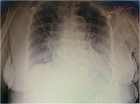 Tctap C A Challenging Case Report Of Complex Critical Left Main