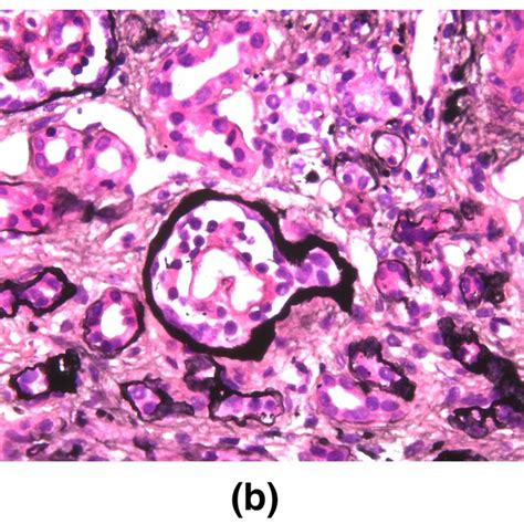 Renal Biopsy Findings Of The Proband A And B Pasm 400× Light