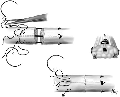 Figure 1 From A Biomechanical Analysis Of The Modified Tsuge Suture