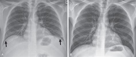 Atelectasis Radiology Key