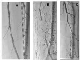 Superficial Femoral Artery Intervention What You Need To Know Vinmec