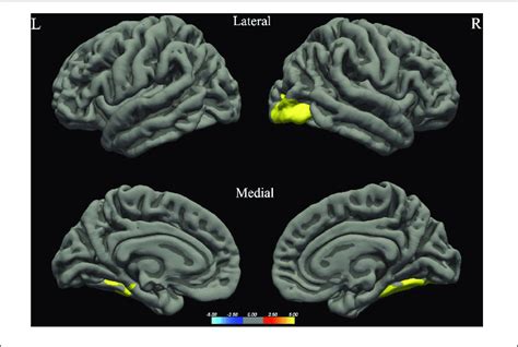 Between Group Differences In Gray Matter Volume Gmv Warm Colors Download Scientific