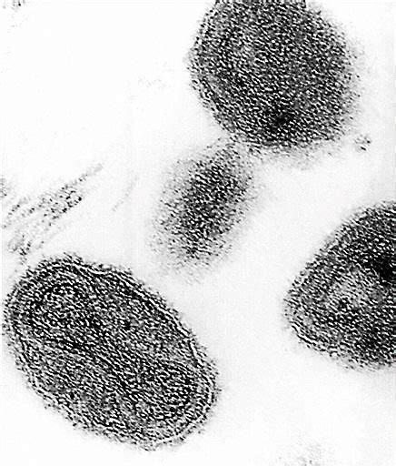 Vials Of Decades Old Smallpox Found At National Institutes Of Health