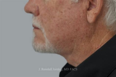 Neck Lift Case Faces Pllc In Ridgeland Ms