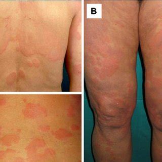 PDF Chronic Spontaneous Urticaria The Emerging Role Of Coagulation