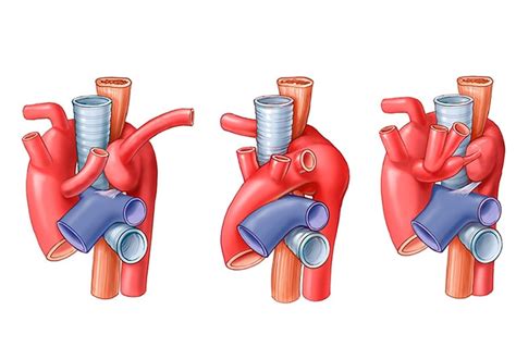 Aortic Ring Surgery