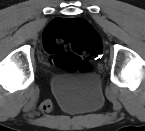 Safety And Efficacy Of Ct Guided Percutaneous Biopsy Of Suspicious