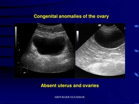 Ultrasonography Of The Ovary