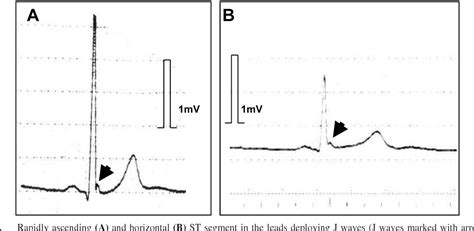 Benign Early Repolarization