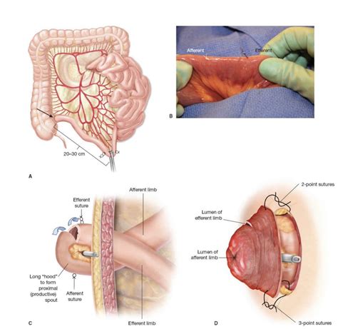 Loop Ileostomy Diagram