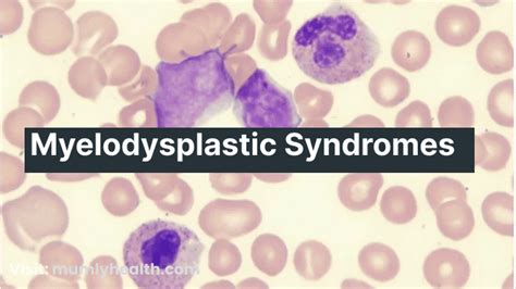 Navigating Myelodysplastic Syndromes Causes Symptoms Challenges