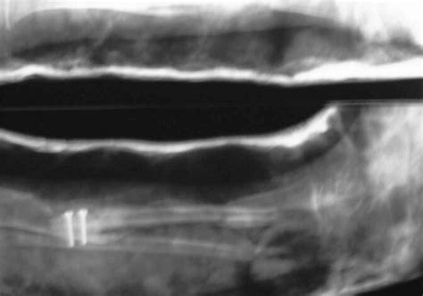 Case 1 Immediate Post Op X Ray Showing Free Fibula Fixed With Screws