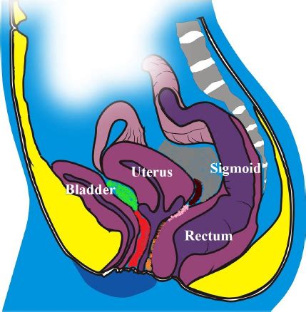 Schematic Drawing Of The Pelvis Demonstrating The Bladder The Uterus