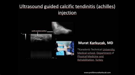 Ultrasound Guided Calcific Tendinitis Achilles Injection Youtube