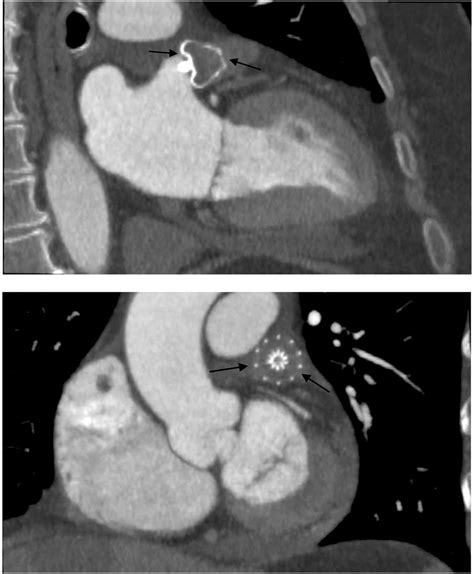 Left Atrial Appendage Occlusion For Stroke Prevention In Patients With