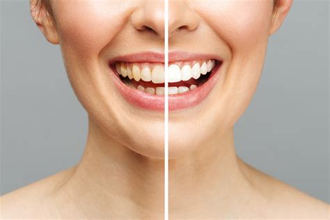 Is Teeth Whitening Safe Teeth Whitening In San Jose Hills Dental