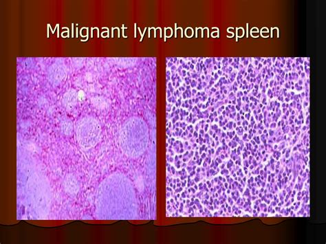 Ppt Splenectomy Complications Powerpoint Presentation Free