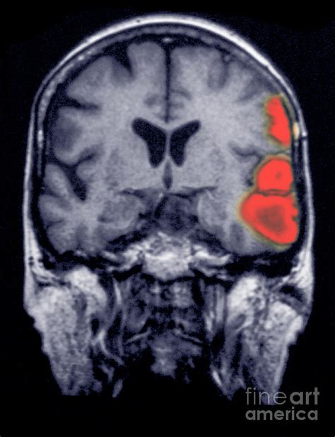 Mri Of Brain Showing A Stroke Photograph By Scott Camazine