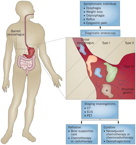 Oesophageal Cancer