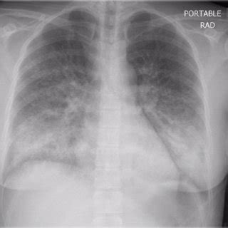 Anterior Posterior AP Portable Chest Radiograph On Admission Showing