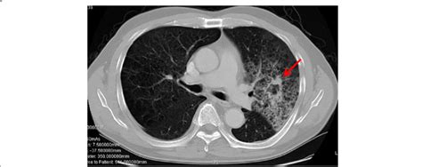 Chest Computed Tomography Ct Revealed A Mm Spiculated