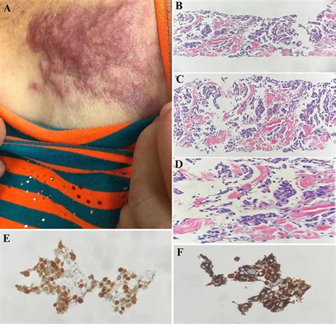 Jle European Journal Of Dermatology Zosteriform Cutaneous