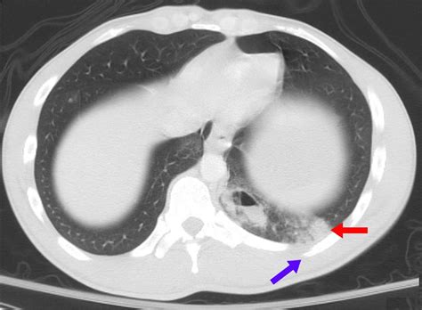 Pulmonary contusion - wikidoc