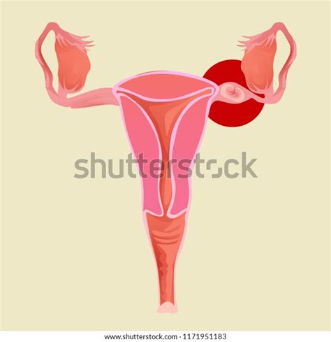 Illustration Uterus Ectopic Pregnancy Gynecology Stock Vector Royalty