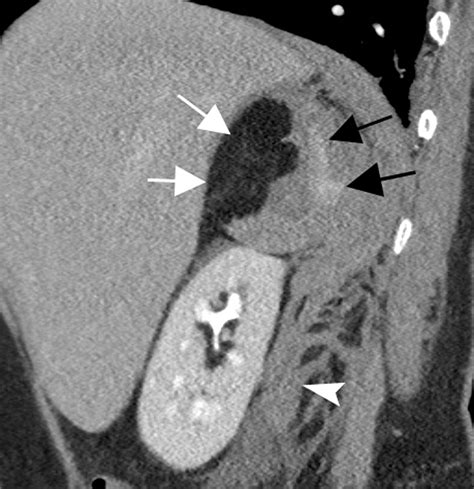 Embolization Of Spontaneous Hemorrhagic Adrenal Myelolipoma With