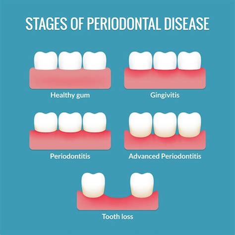 Diferencia Entre Gingivitis Y Periodontitis Conoce Las Distinciones