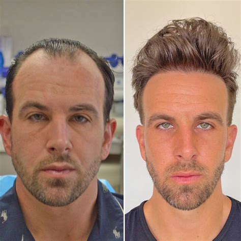 Hair Transplant Before And After