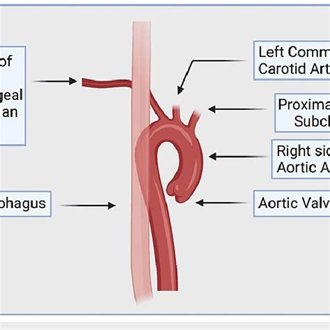 Illustration Of The Distal Origin Of The Aberrant Right Subclavian Download Scientific Diagram