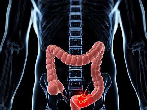 Colonic Colorectal Polyps Causes Symptoms And Diagnosis