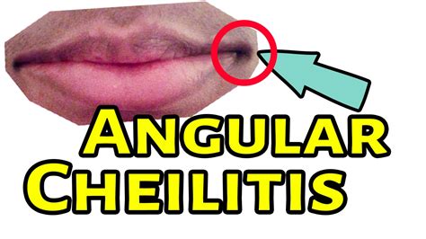 Angular Cheilitis Treatment Angular Cheilitis Home Remedies Youtube