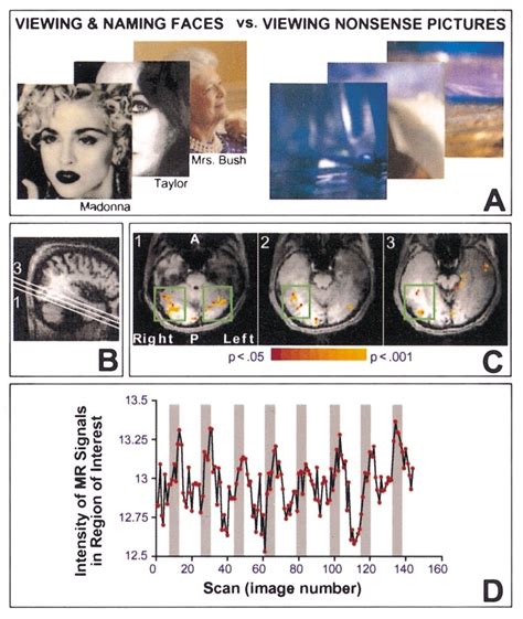 Activation of fusiform gyrus caused by recognizing familiar faces. A ...