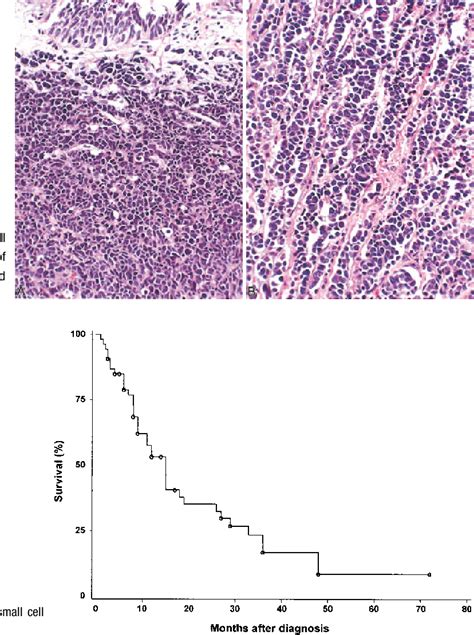 Figure From Small Cell Carcinoma Of The Urinary Bladder Semantic