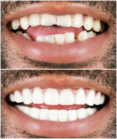 Dental Crowns In Turkey Cost Zirconium Porcelain E Max Tajmeel Center