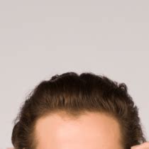 Why Is My Hairline Uneven? How To Combat A Receding Hairline - Skalp