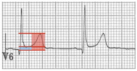 Benign Early Repolarisation • Litfl • Ecg Library Diagnosis