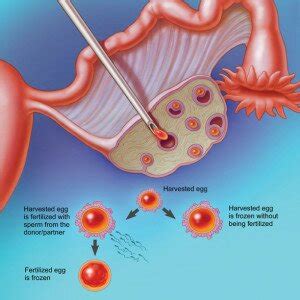 Cryopreservation Of Eggs Sperm Embryos