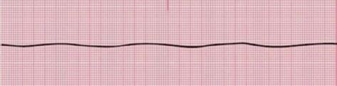 Chapter 9 Ventricular Dysrhythmia Flashcards Quizlet
