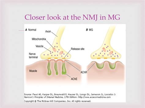 Ppt Neuromuscular Junction Disorders Powerpoint Presentation Free