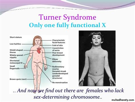 Turner Syndrome Ambiguous Genitalia