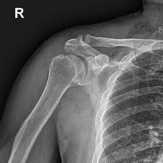 Sinding Larsen Johansson Disease Longitudinal Ultrasonographic Image