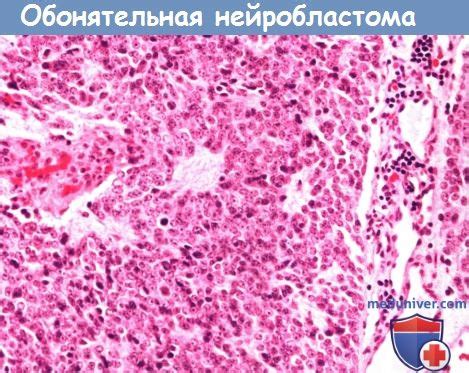 Клиника, диагностика, лечение обонятельной нейробластомы ...