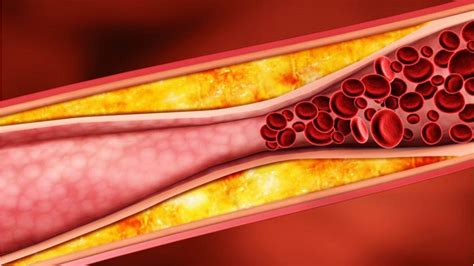Colesterol Mira Los Síntomas Graves De Arterias Tapadas