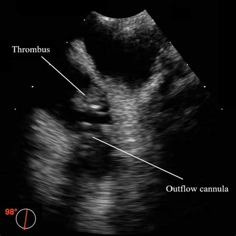 Upper Esophageal Aortic Arch Short Axis Ue Aa Sax View With