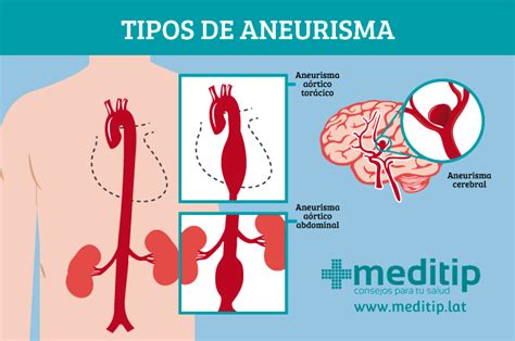 Aneurisma Tipos Causas Y Tratamiento Meditip